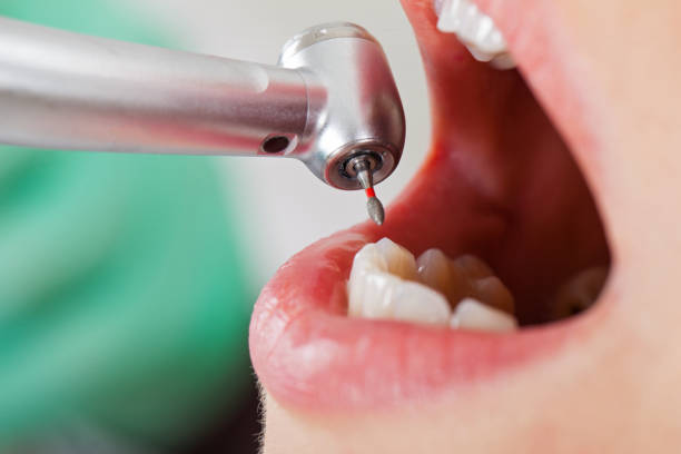 Best Emergency Dentist for Knocked-Out Tooth in Queen City, TX